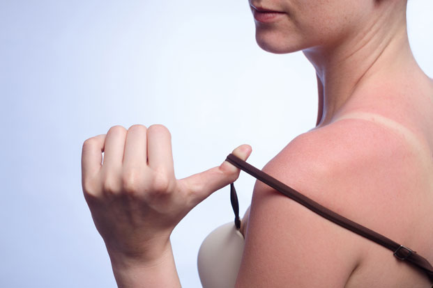 The Best Home Remedies for Sunburn