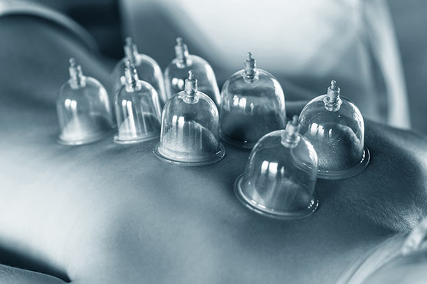 What You Need to Know About Cupping