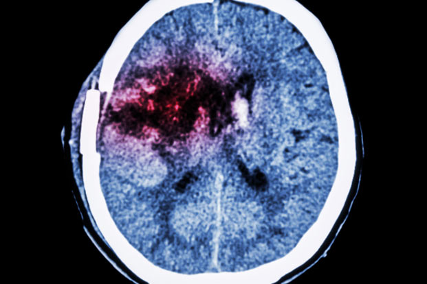 How to Recognize Stroke Signs– and Act Fast