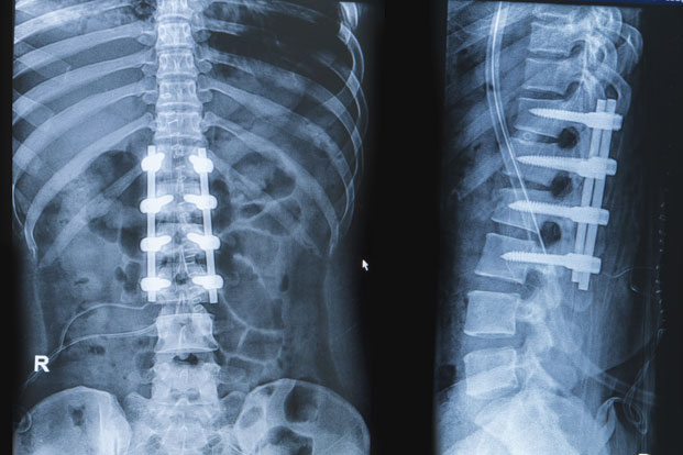 Spinal Fusion-Are You a Candidate?